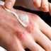 7 Eczema Treatments Dermatologists Use on Themselves