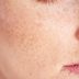 7 Skincare Rules Everyone With Freckles Should Know