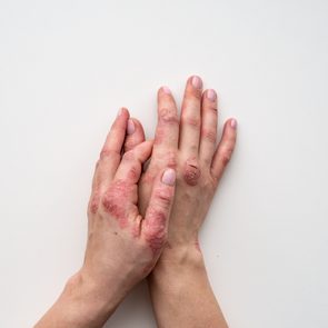 Psoriasis skin. Closeup of rash and scaling on the patient's skin. The concept of chronic disease treatment. Dermatological problems. Hard, horny and cracked skin in woman's hands. Dry skin. Isolated