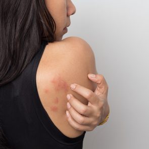 woman showing her skin itching behind , with allergy rash urticaria symptoms