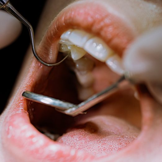 Close Up Female Patient Open Mouth For Dentist Examining Her Tooth Routine Check Up