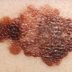 New Study: Low Levels of This Vitamin May Increase Melanoma Skin Cancer Risk