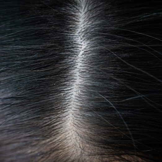 Close Up Of Dandruff